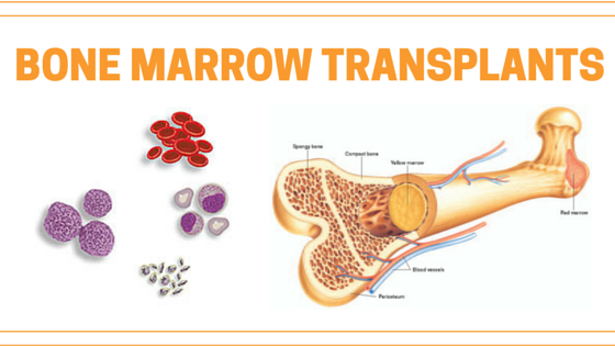 Bone Marrow Transplant Mandl School The College Of Allied Health